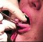 piercing sur la langue